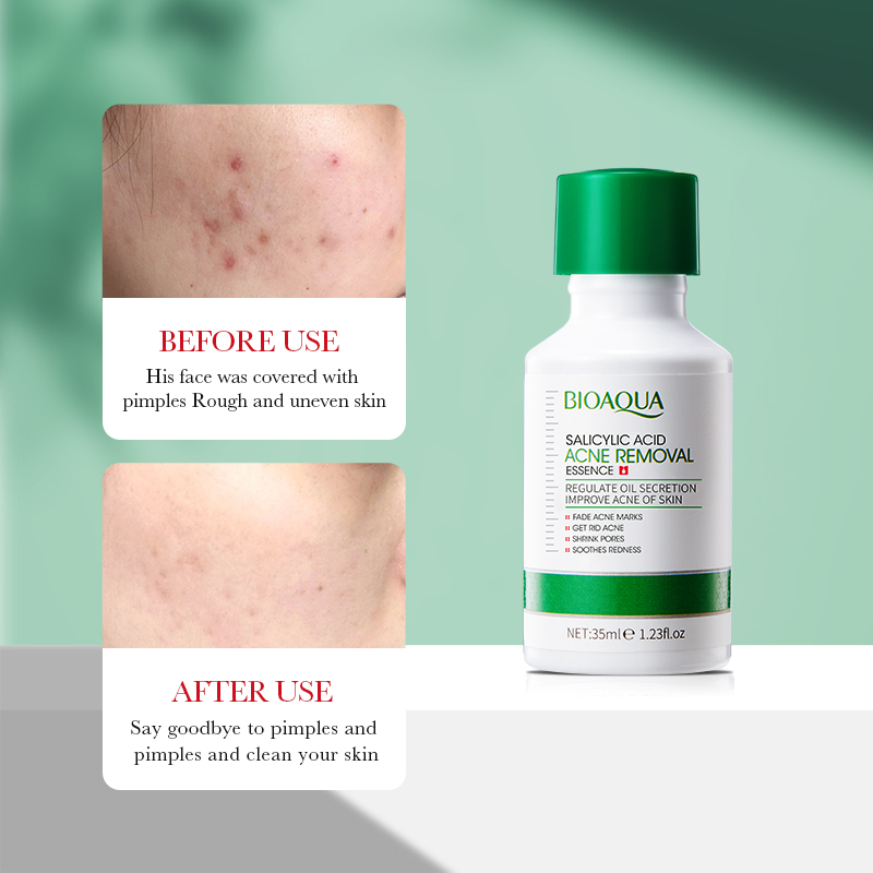 Esencia de eliminación antiacn - Salicylic Acid Blackhead Remover reseña y precio