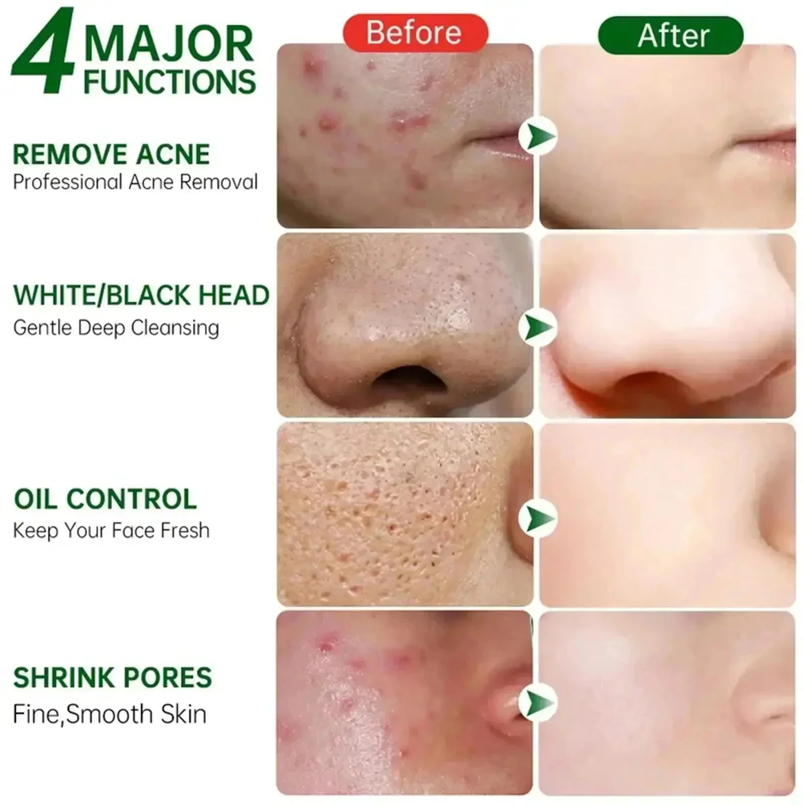 Crema limpiadora de poros de á - Salicylic Acid Blackhead Remover reseña y precio