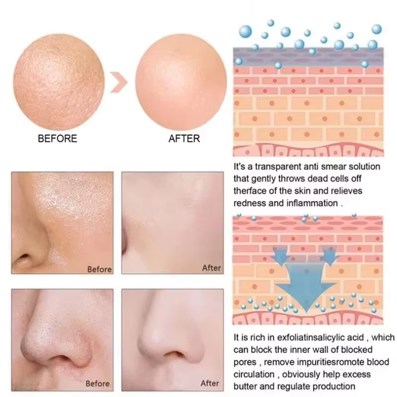 Suero Reductor de Poros con Ác - Salicylic Acid Blackhead Remover reseña y precio